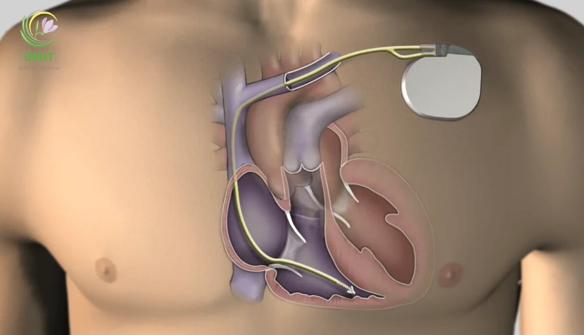 Кардиостимулятор сердца. Кардиовертер-дефибриллятор. Имплантируемый кардиовертер-дефибриллятор. Имплантация кардиовертеров-дефибрилляторов. Трехкамерный кардиовертер-дефибриллятор.