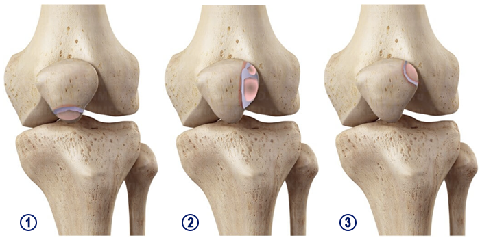 
Классификация двудольного надколенника по расположению меньшего костного фрагмента (классификация по Saupe).
1 – I тип: фрагмент находится в нижней части коленной чашечки. Встречаемость – около 5%.
2 – II тип: фрагмент находится на латеральной (внешней) стороне коленной чашечки. Встречаемость – около 20%.
3 – III тип: фрагмент находится в верхненаружной части коленной чашечки. Встречаемость – около 75%.