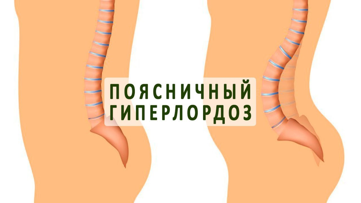 Какими упражнениями вернуть осанку если у вас гиперлордоз и что такое гиполордоз
