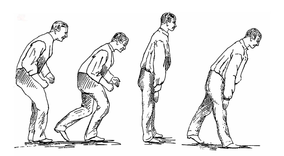 Центр паркинсонизма. Походка Паркинсона. Болезнь Паркинсона поза просителя. Постуральная неустойчивость при болезни Паркинсона. Походка при болезни Паркинсона.