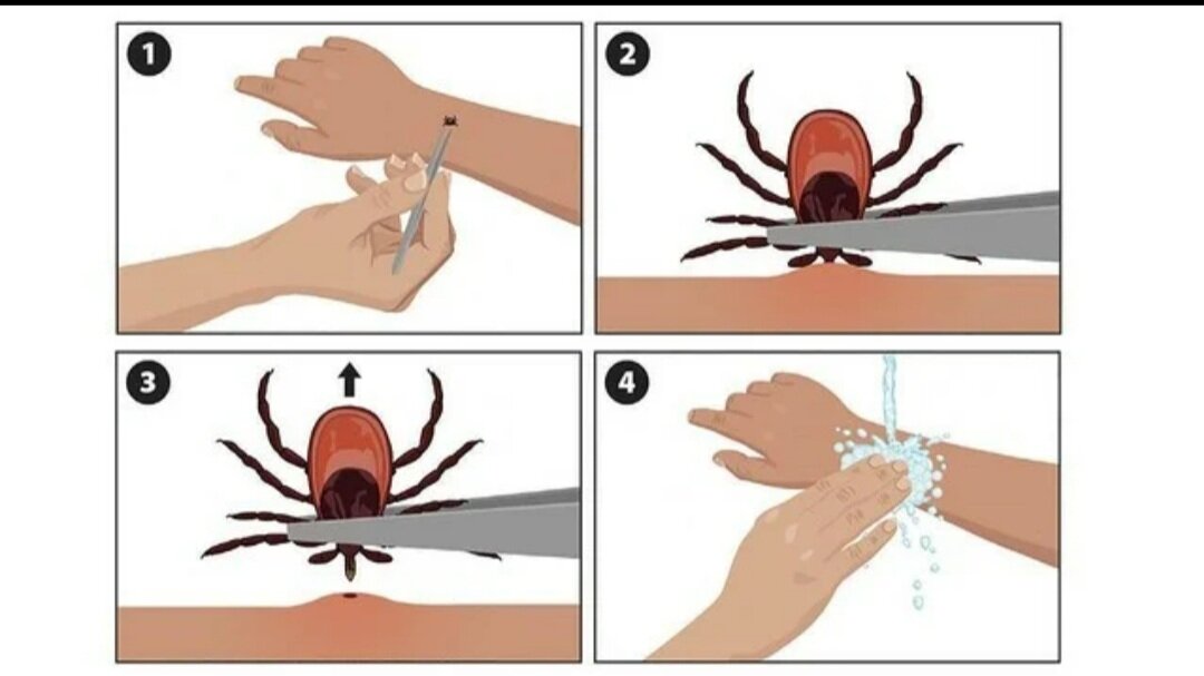 Укусил клещ чем обработать место. Места присасывания клеща схема. Ранка после укуса клеща у человека.