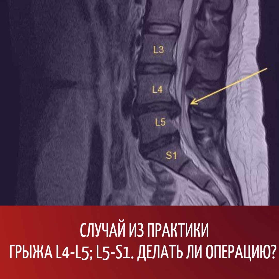 Грыжа l4 l5. Грыжа l5-s1. Грыжи межпозвонковых дисков l4-l5 l5-s1. Межпозвоночная грыжа l4-l5.