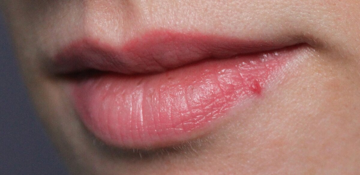 Как избавиться от гемангиомы на поверхности губы