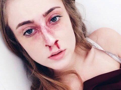  При переломе носа нужно незамедлительно обращаться к врачу