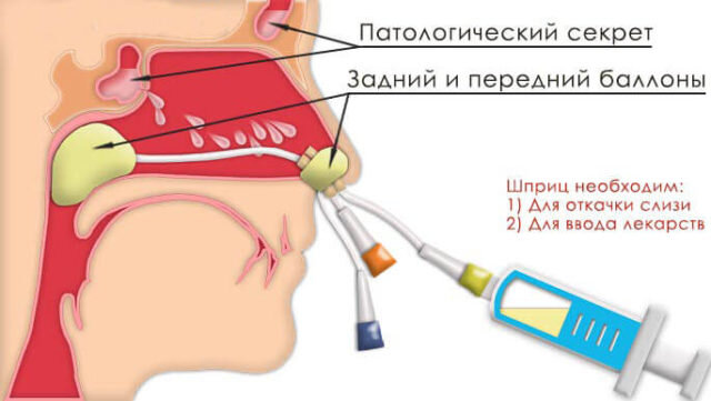 Лечение​ ​гайморита