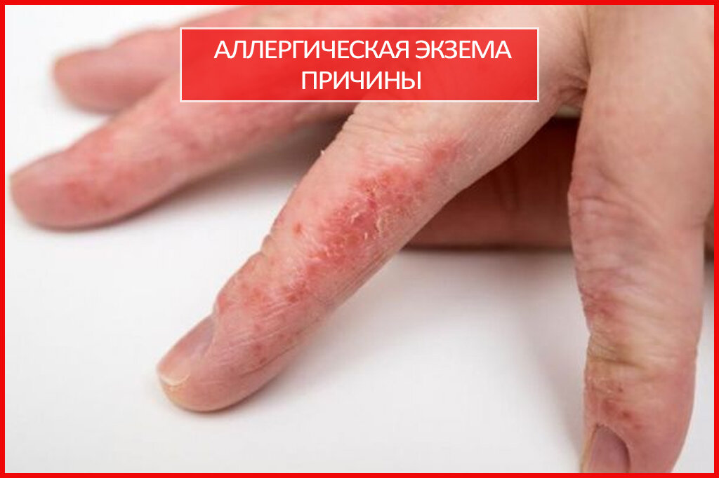  Аллергическая экзема   Аллергическая экзема такое заболевание, при котором происходят изменения здоровых покровов кожи, проявляющиеся воспалительным процессом и сопровождающиеся нервно-аллергическим
