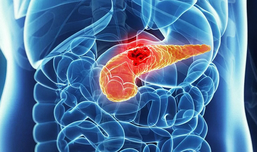 Рак поджелудочной железы