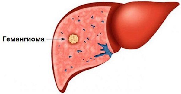 Симптомы гемангиомы печени