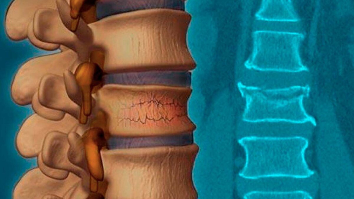 Перелом поясничного позвоночника