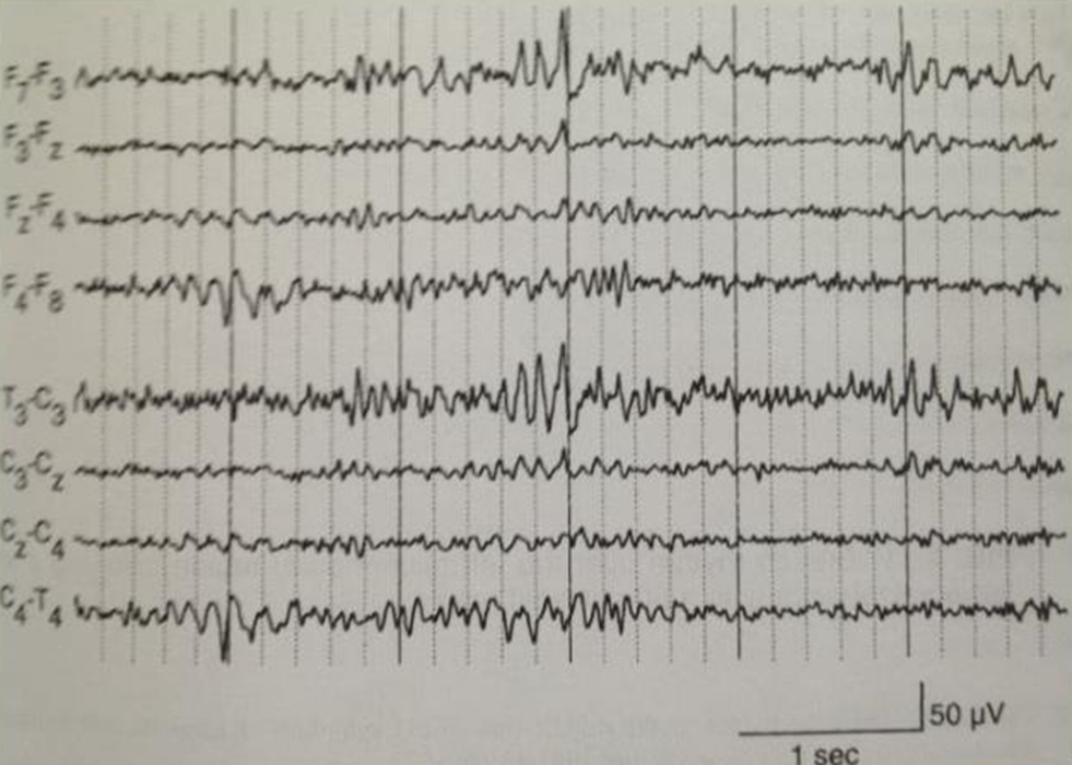 Example of Wicket waves, non epilepticus