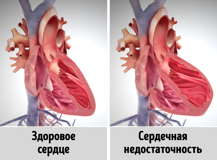 Сердечный приступ. Тяжело на сердце что это. Инфаркт миокарда. Тяжело на душе. Сердце при инфаркте миокарда.