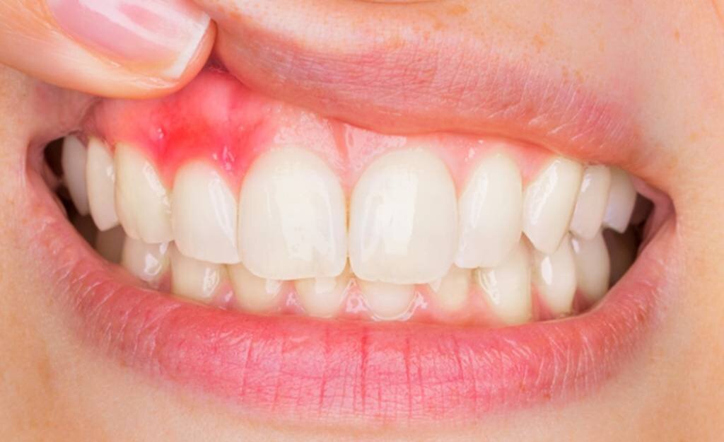 Десна играют важную роль в защите корней зубов от разрушения. Чаще всего заболевания десен развиваются в области десневых карманов.