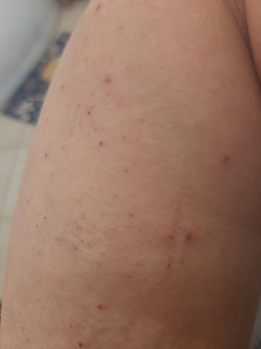 Это укусы за час.