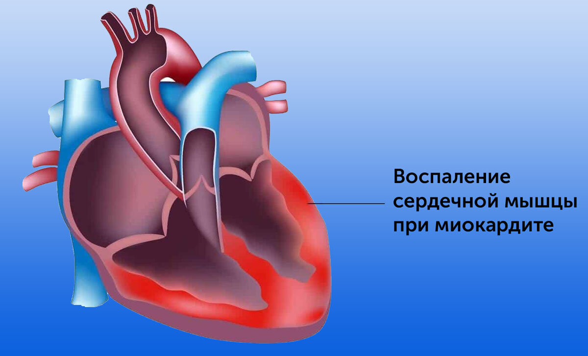 Влияние коронавируса на сердце | Международная клиника MEDICA24 | Дзен