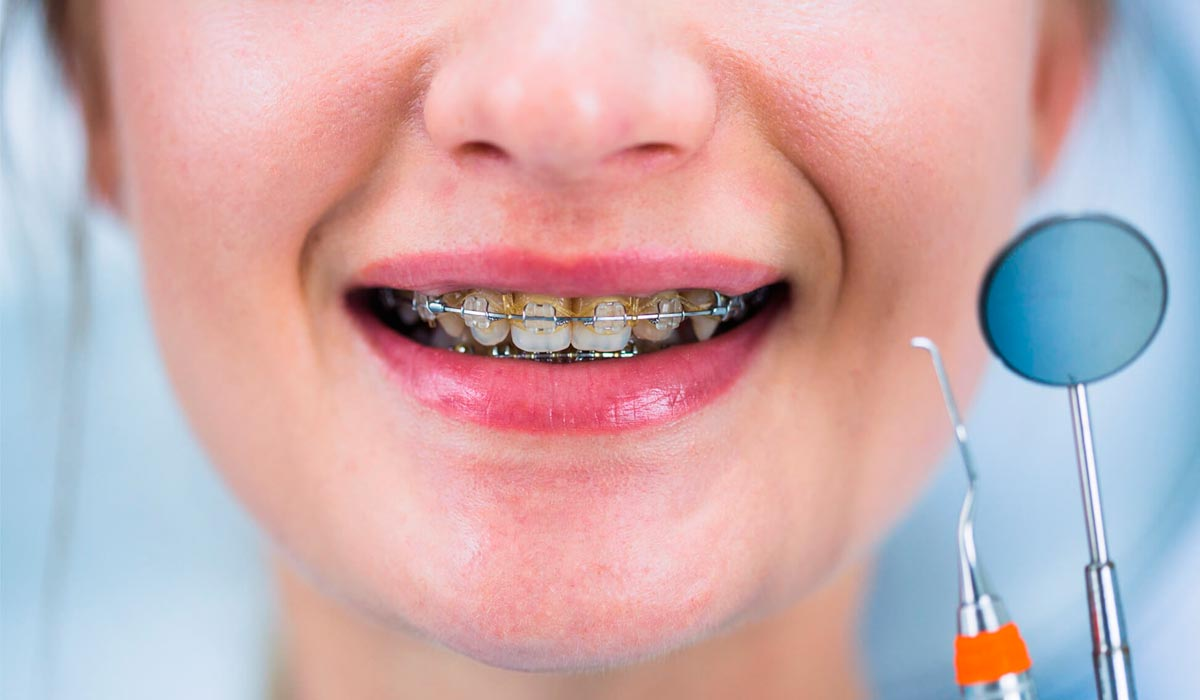гигиена полости рта с брекет системой. лигатурные и безлигатурные брекеты. лечат ли зубы с брекетами. ортодонтия зубов. лечат ли зубы с брекетами.