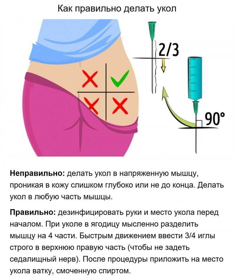 Куда колоть в ягодицу схема фото