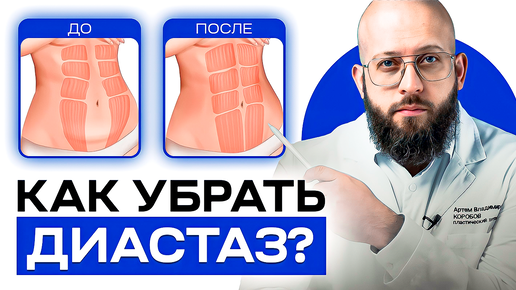 Descargar video: Что такое диастаз и как его определить. Методы лечения диастаза