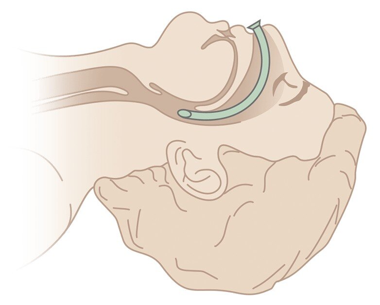 Воздуховод орофарингеальный гведела 50 мм. Воздуховод гведела apexmed 90 мм. Воздуховоды дыхание. Воздуховод mederen орофарингеальный гведела, размер 2. Воздуховоды дыхание.