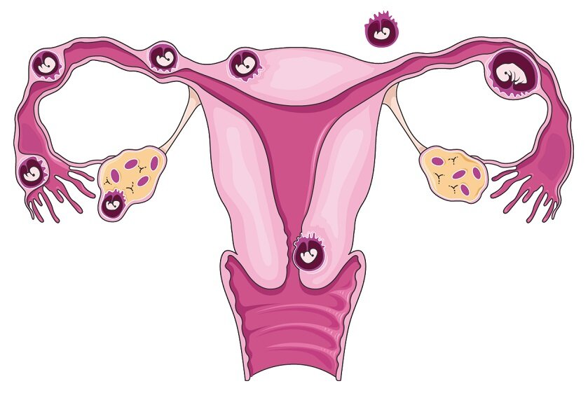 фото из открытых источников, демонстрирует варианты локализации внематочной беременнсоти