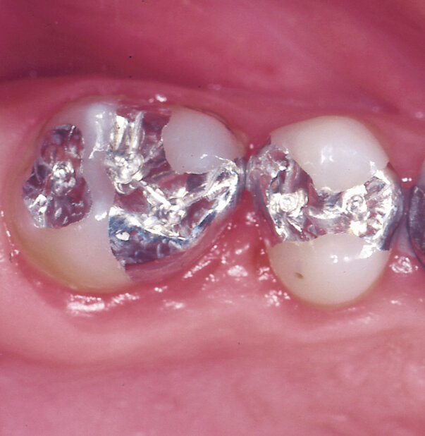 АМАЛЬГАМОВЫЕ ПЛОМБЫ И ИХ ТОКСИЧНОСТЬ | Белая радуга | Сеть ...
