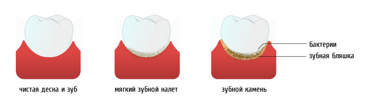 Этапы возникновения зубного камня