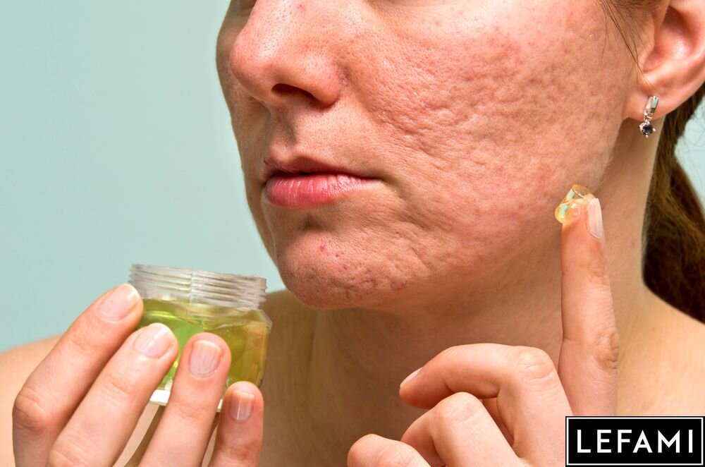 Влияние диеты на развитие рака кожи