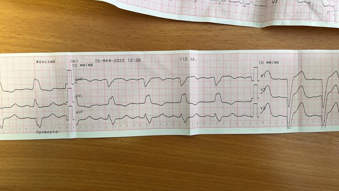 ЭКГ пациентки 2.Фото сделаны автором.