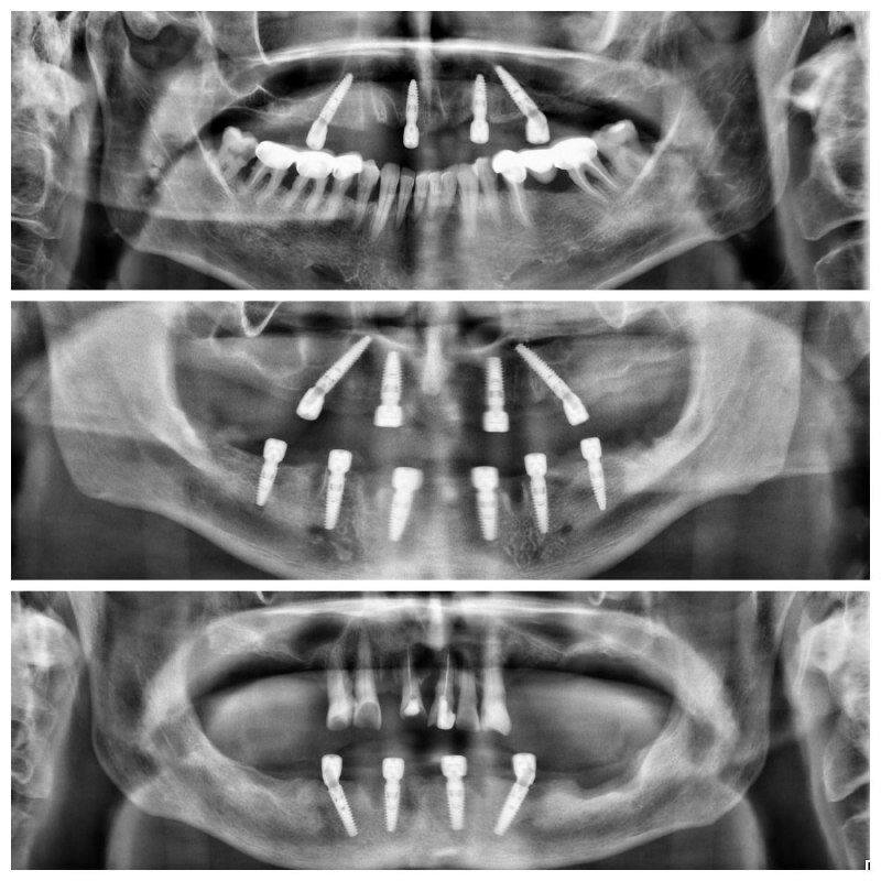 Меня часто спрашивают о стремительно набирающей в России популярность стоматологической операции «All-on-4» и «All-on-6». Отвечаю.-2