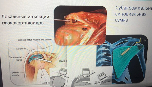 Разрыв суставной губы