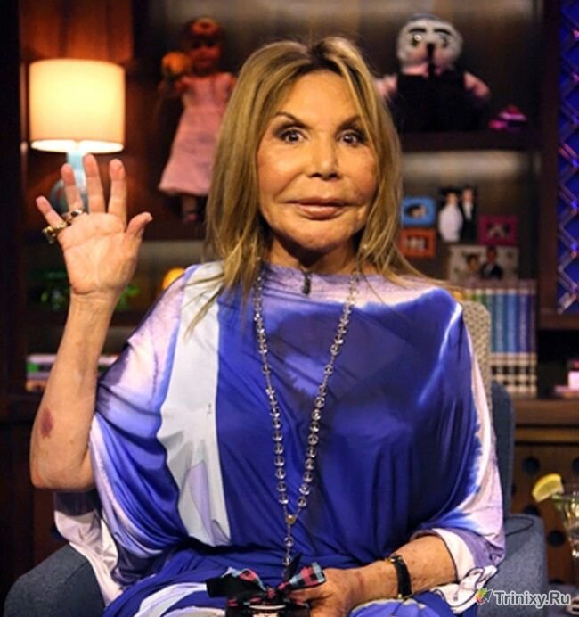 Бывшая звезда американского реалити-шоу «Реальные домохозяйки Майами» Эльза Паттон была показательным примером переизбытка пластических операций. 