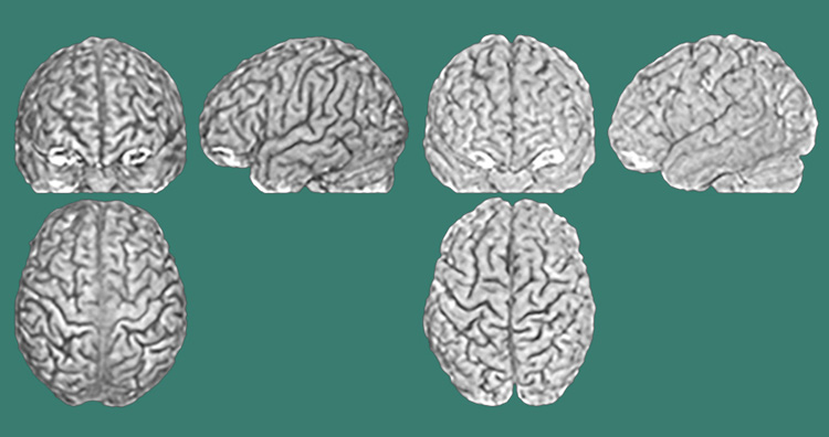 Три снимка мозга (спереди, сбоку и сверху) двух разных мозгов (на фото слева и справа), принадлежащих близнецам. Борозды и гребни различны у каждого человека. Источник изображения: Lutz Jäncke/UZH 