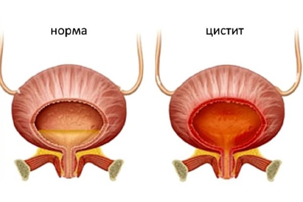 Хронический цистит