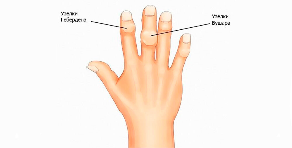 Узелки бушара лечение. Узелки Гебердена заболевание. Средний палец узелки Бушара.