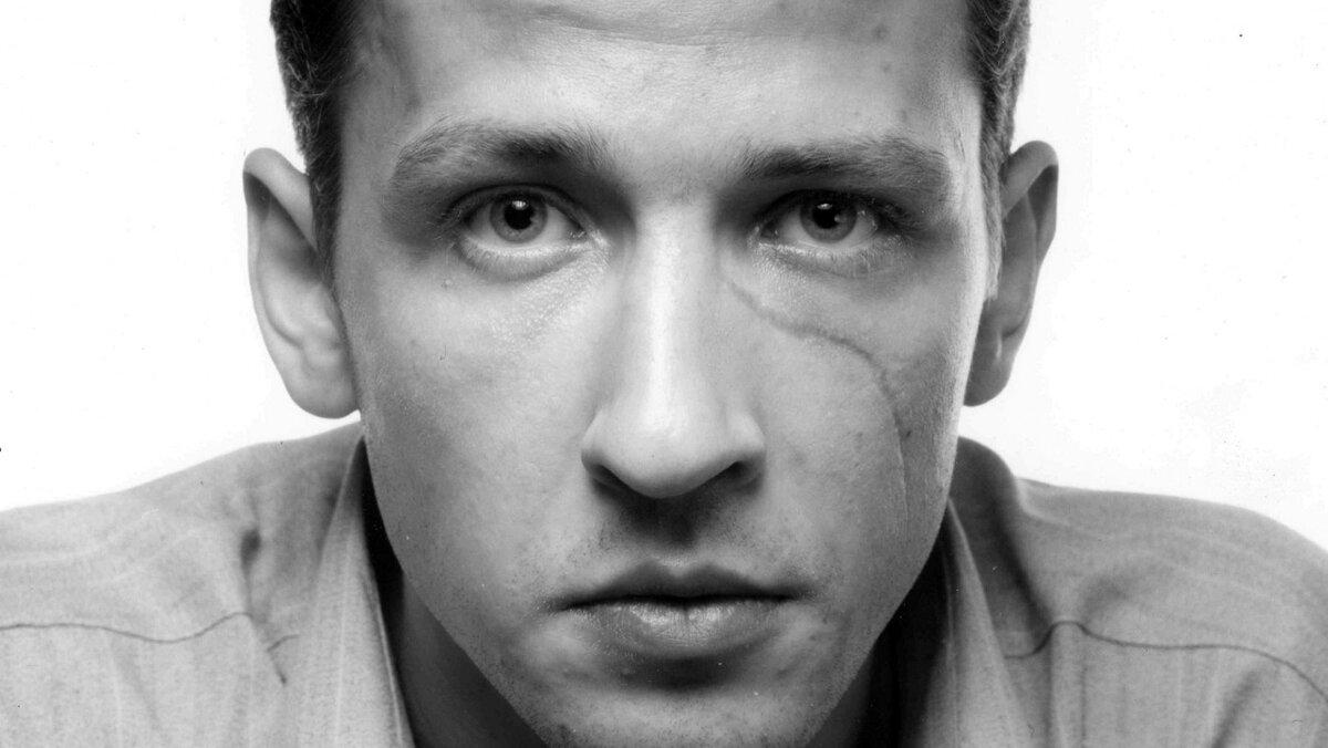 В детстве Рыжий случайно поранил лицо осколками стеклянной банки, шрам остался на всю жизнь.