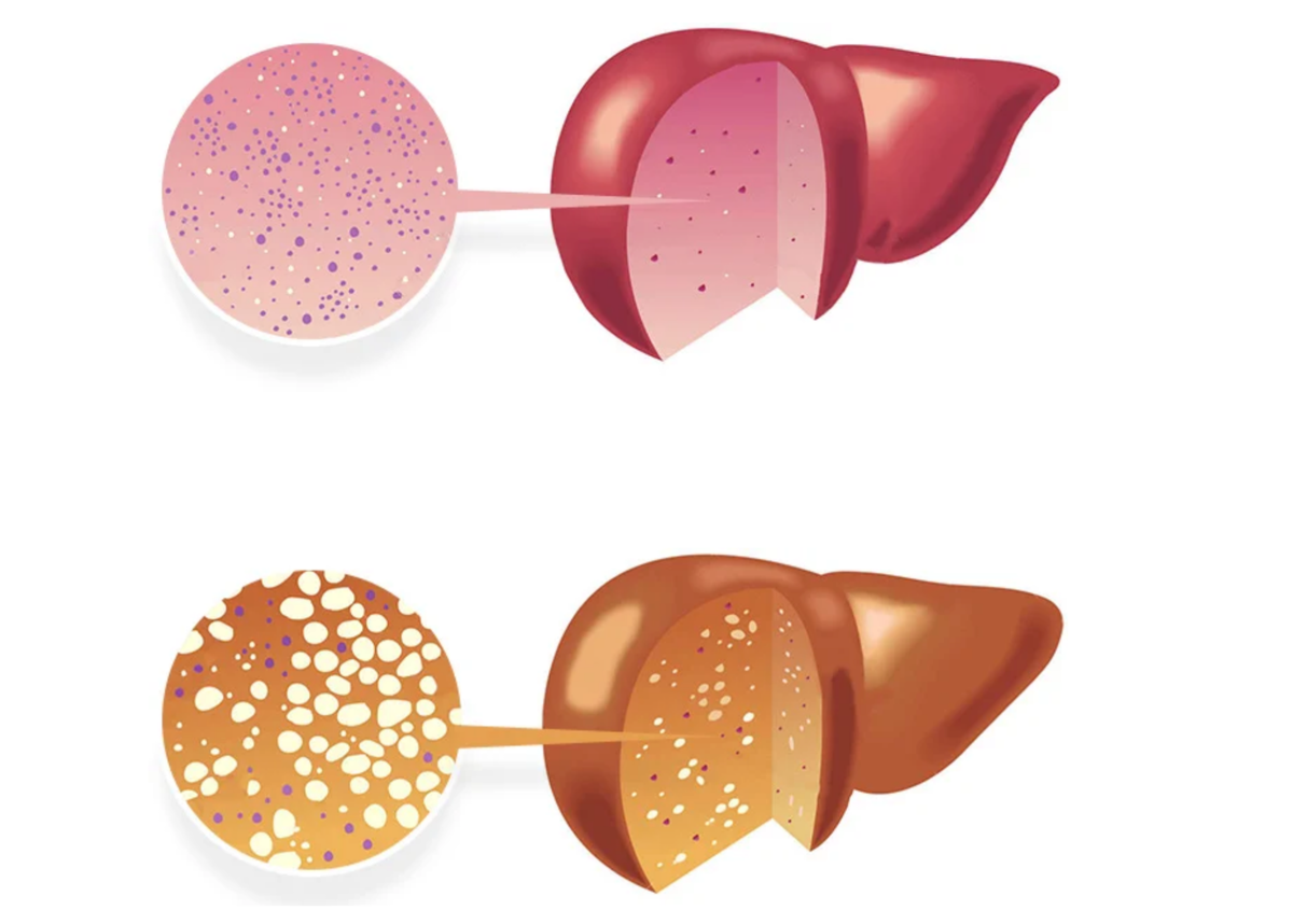 Жировой гепатоз печени причины