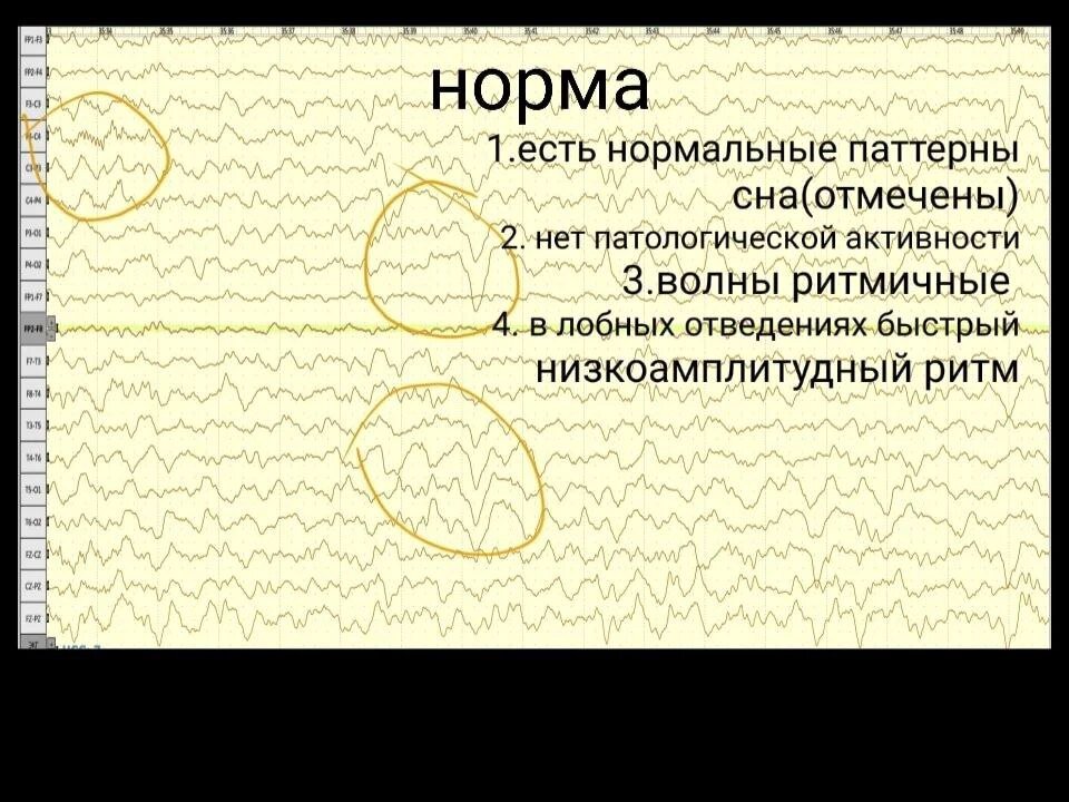 Нормальное ЭЭГ. Ниже представлено изображение с паттерном Гипсаритмия. Постарайтесь заметить отличия!