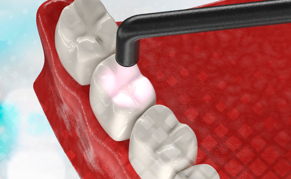 Без лампы при современном лечении не обойтись – она нужна для того, чтобы жидкий пломбировочный материал принял твердую форму. Smile-at-Once.ru.