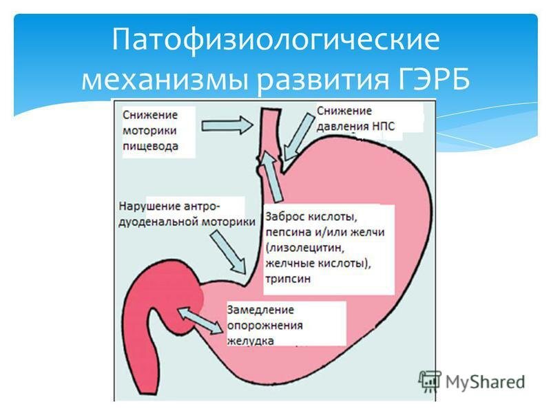 Лечение ГЭРБ (гастроэзофагеального рефлюкса) | Добромед