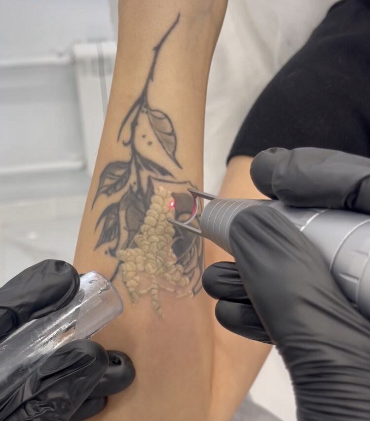 Процесс лазерного удаления тату в клинике Sokolov.Laser с характерным для первого сеанса фростом. 