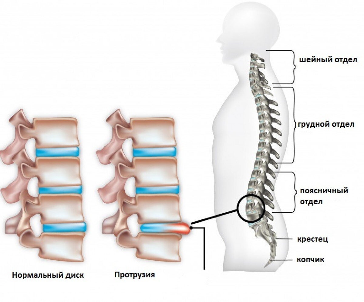 Espondilosis lumbar tratamiento