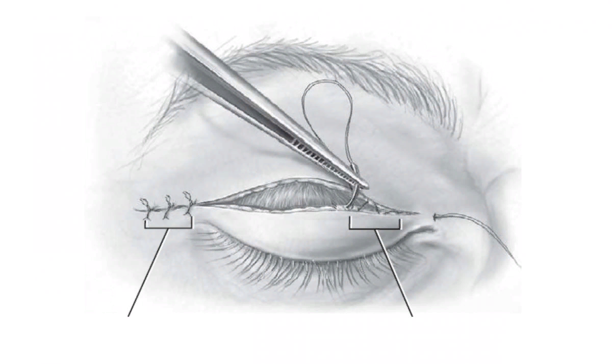 Блефаропластика верхняя операции. Пинч блефаропластика нижних век. Блефаропластика верхних век разрез. Блефаропластика верхних век шов после операции.