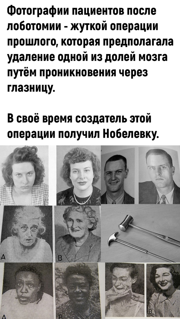 Что такое лоботомия картинки до и после