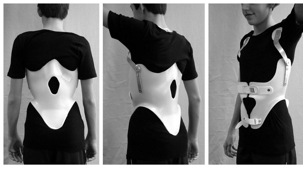     У 12-летней Амалии в 2017 году был диагностирован сахарный диабет. В 2020 году врачи обнаружили у девочки искривление позвоночника. Специалисты рекомендовали девочке носить жесткий корсет. Однако Главное бюро МСЭ КБР упорно отказывается вносить его в индивидуальную программу реабилитации.