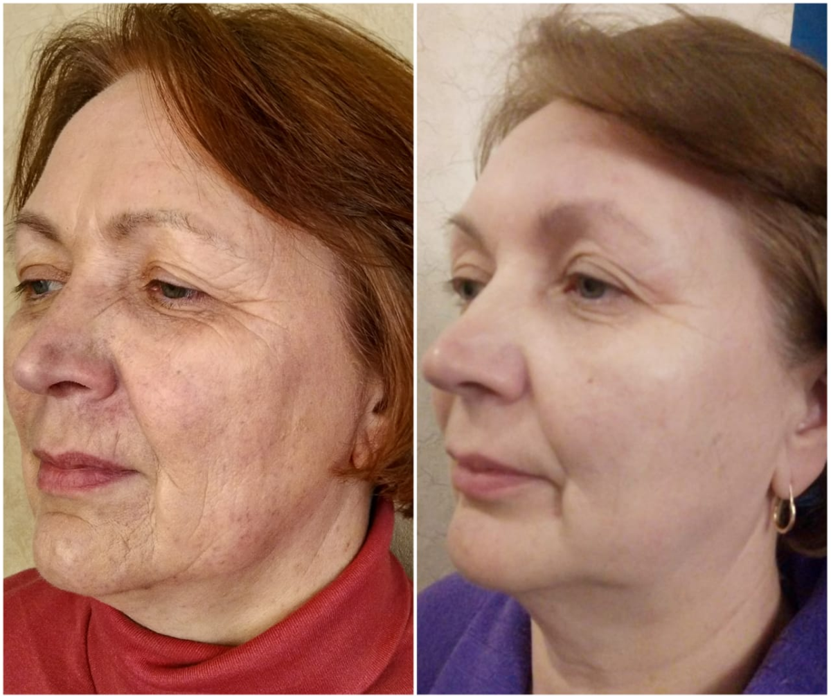 Процедура для лица после 60. Косметология лица до и после. Омоложение лица. До и после процедур лицо. Аппаратная косметология до и после.