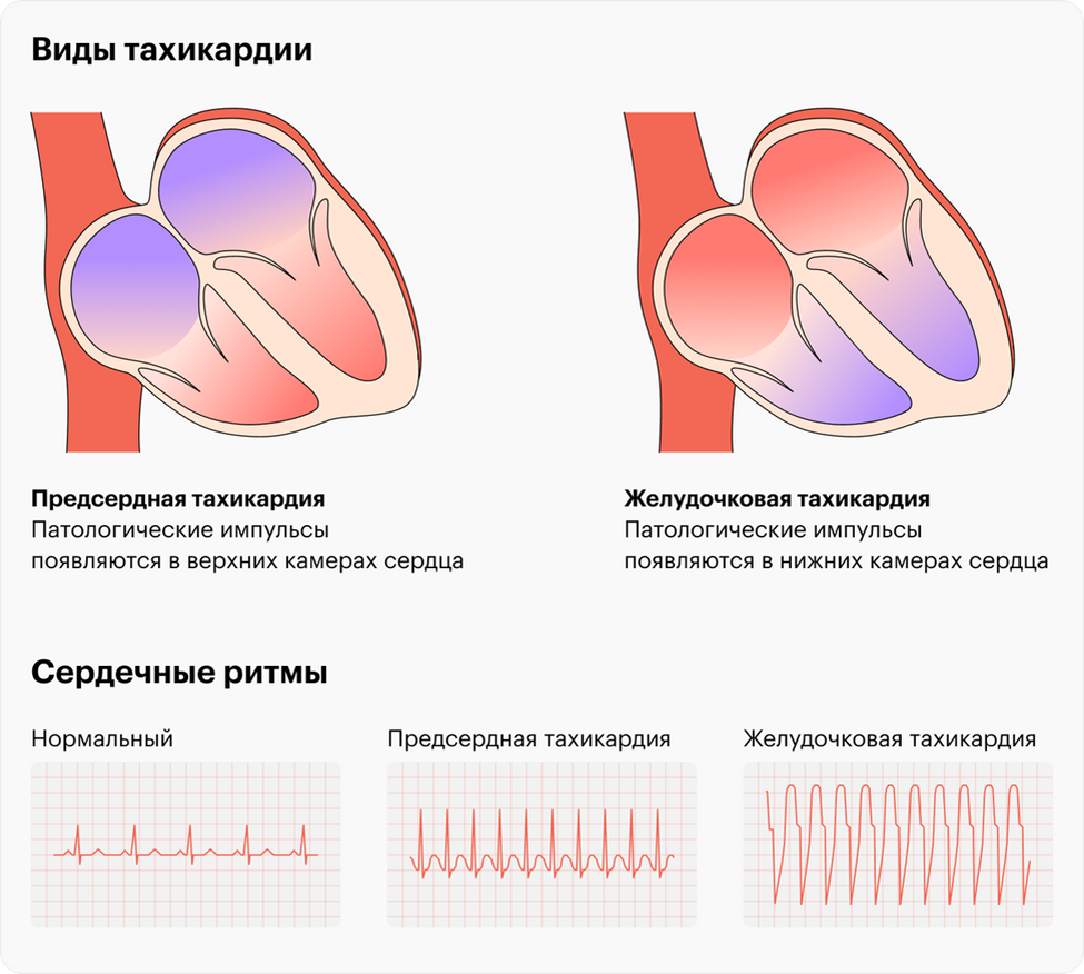 Тахикардия что