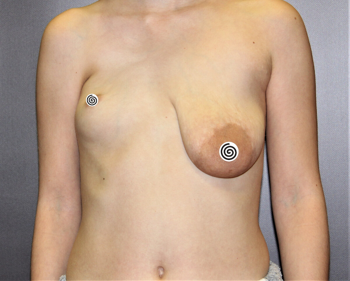 Синдром Поланда у женщины.