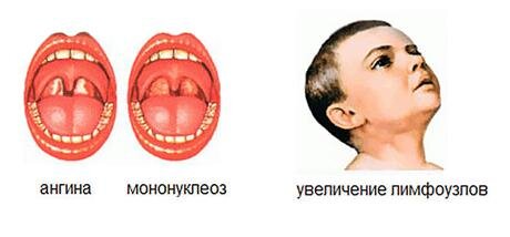 Мононуклеоз у детей картинки