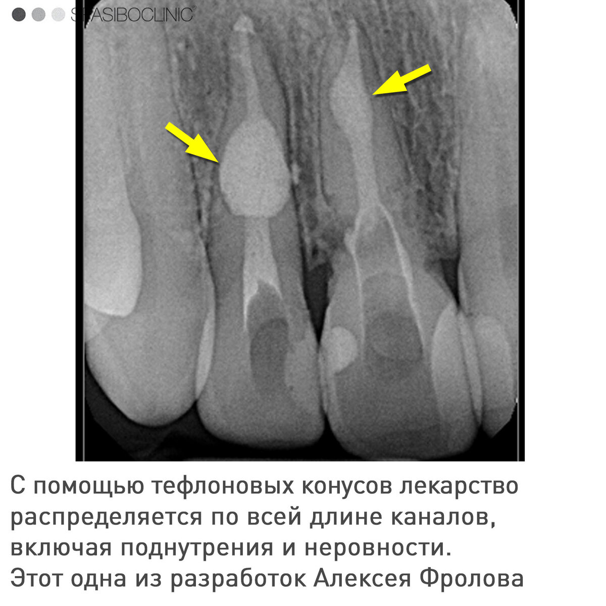 РЕЗОРБЦИЯ КОРНЕЙ | Спасибо.Клиник | Дзен