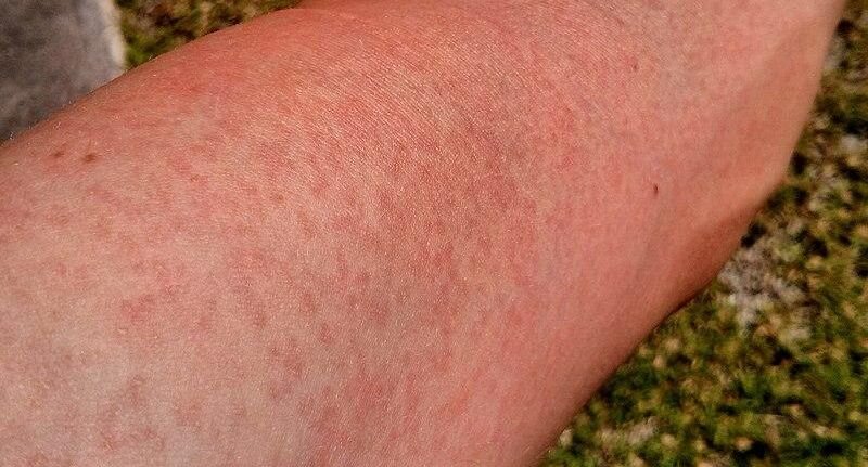 Сыпь на руке, вызванная вирусом Зика📷
