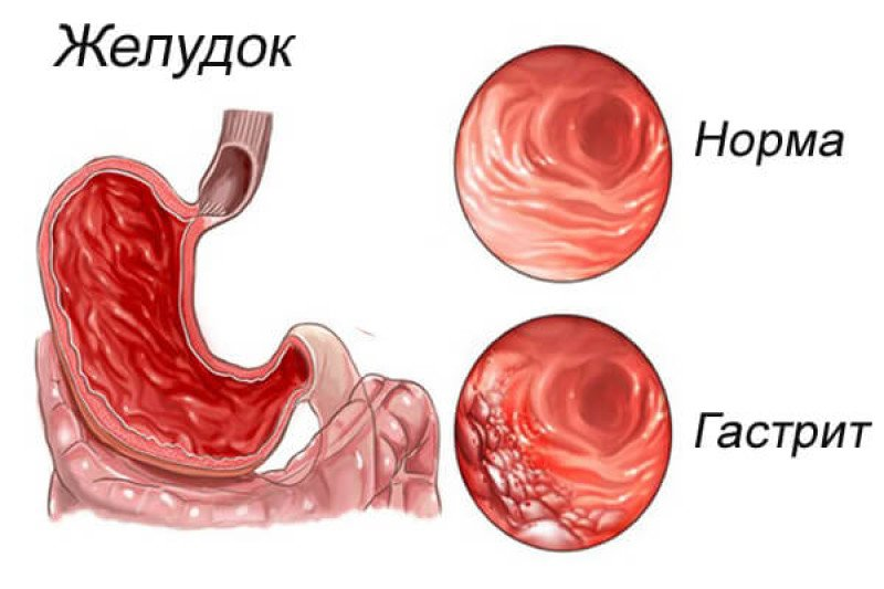 Гастрит краткая характеристика